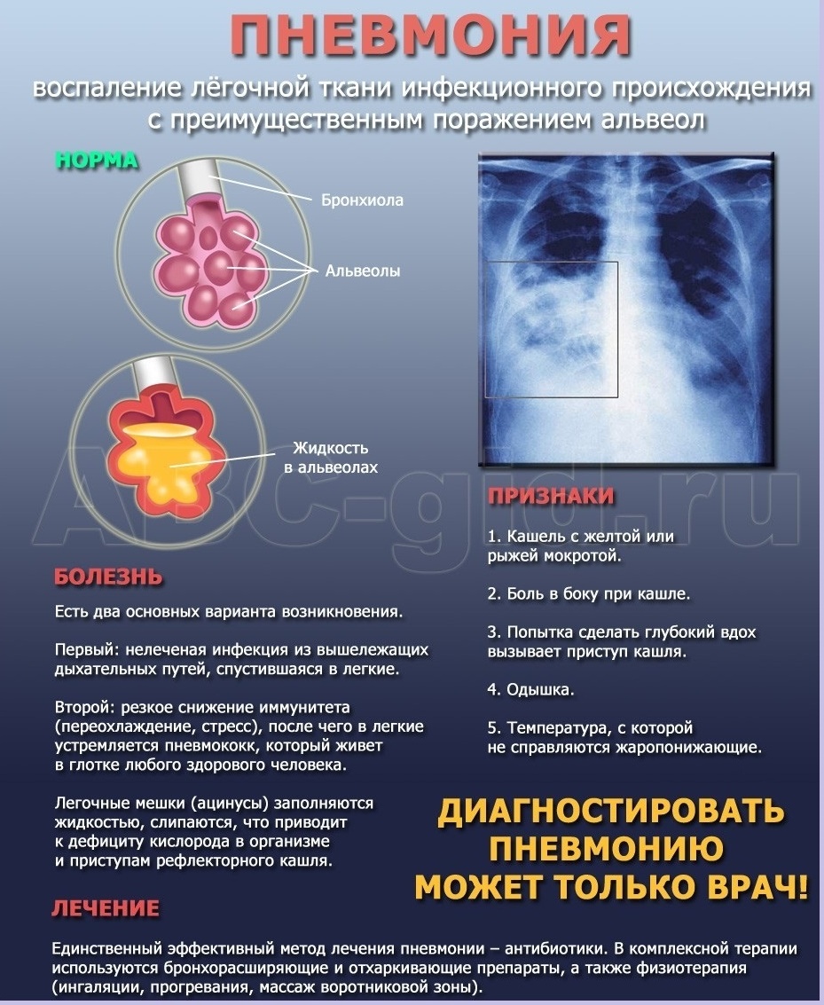 Профилактика пневмонии.